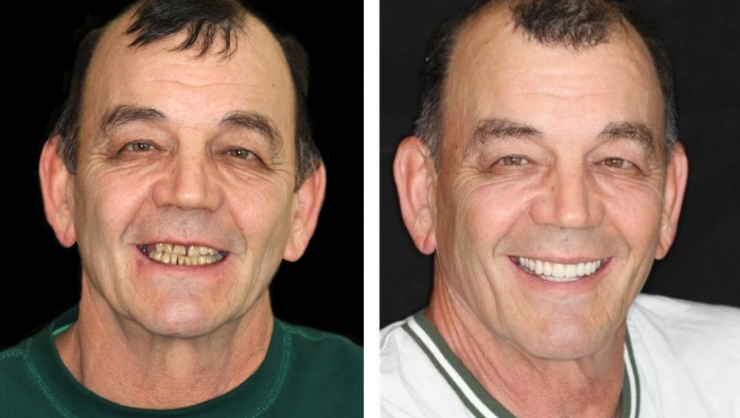 NESLEMY™ --🦷Advanced Customized Full Denture Set🦷 {Developed by Harvard University}