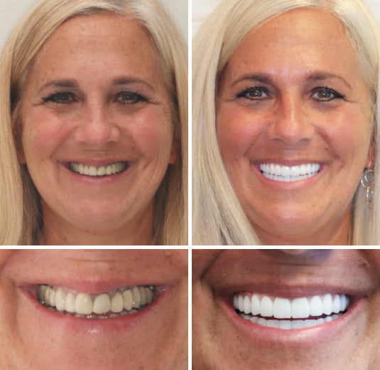 NESLEMY™ --🦷Advanced Customized Full Denture Set🦷 {Developed by Harvard University}