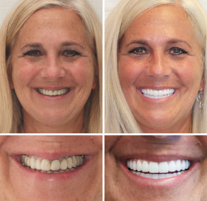 NESLEMY™ --🦷Advanced Customized Full Denture Set🦷 {Developed by Harvard University}