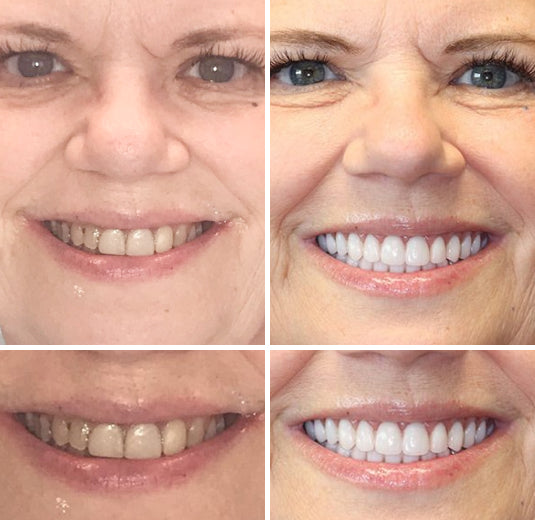 NESLEMY™ --🦷Advanced Customized Full Denture Set🦷 {Developed by Harvard University}