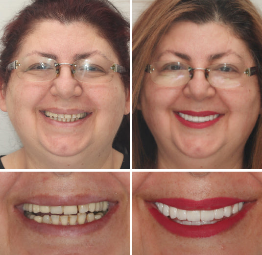 NESLEMY™ --🦷Advanced Customized Full Denture Set🦷 {Developed by Harvard University}