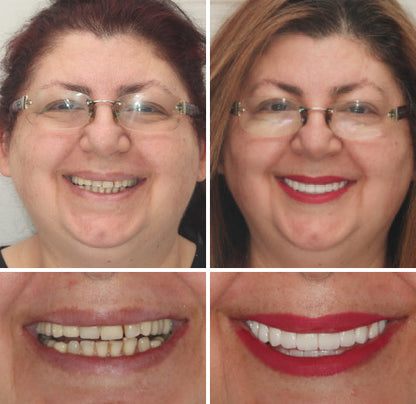 NESLEMY™ --🦷Advanced Customized Full Denture Set🦷 {Developed by Harvard University}