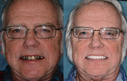 NESLEMY™ --🦷Advanced Customized Full Denture Set🦷 {Developed by Harvard University}