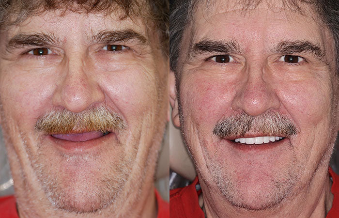 NESLEMY™ --🦷Advanced Customized Full Denture Set🦷 {Developed by Harvard University}